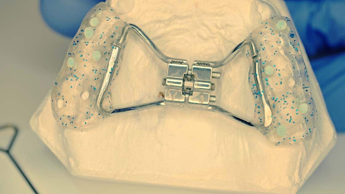 Palatal Expander Device